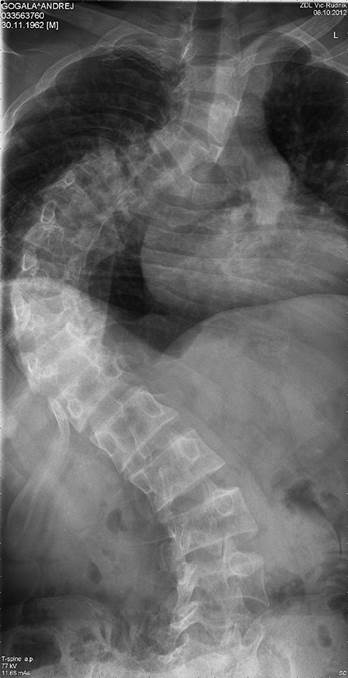 x-ray 2012 thoracic mala